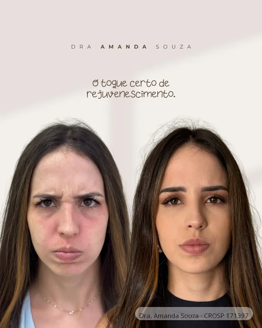 Antes e depois de toxina botulínica na glabela realizado pela Dra. Amanda Souza