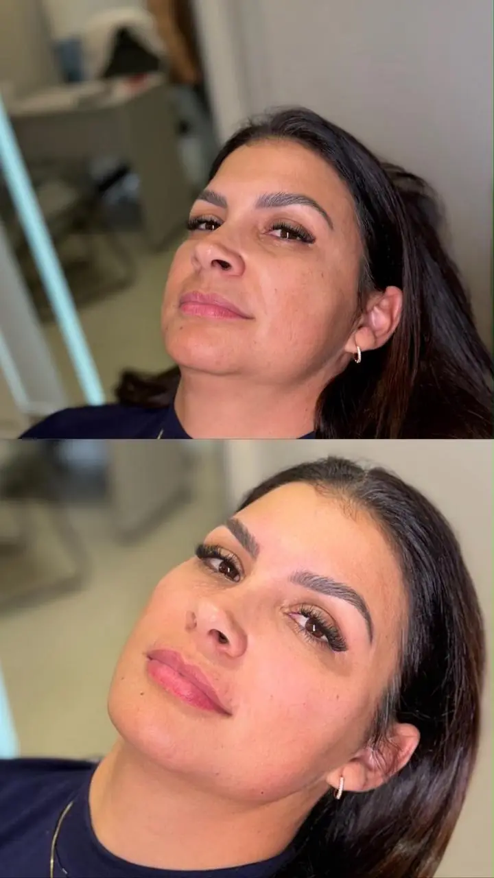 Antes e depois de harmonização facial realizado pela Dra. Amanda Souza