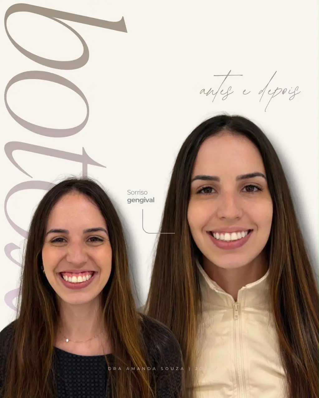 Antes e depois de sorriso gengival realizado pela Dra. Amanda Souza