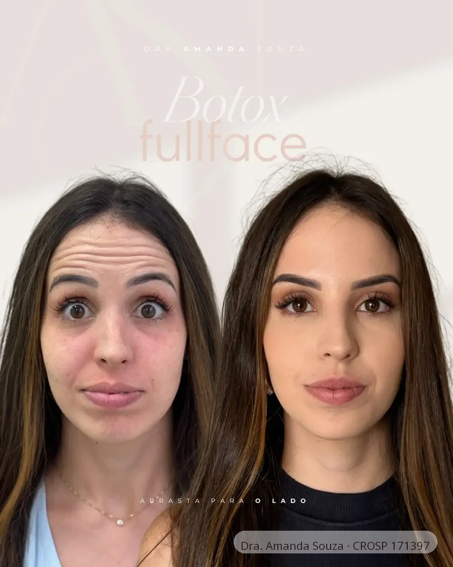 Antes e depois de botox full face realizado pela Dra. Amanda Souza