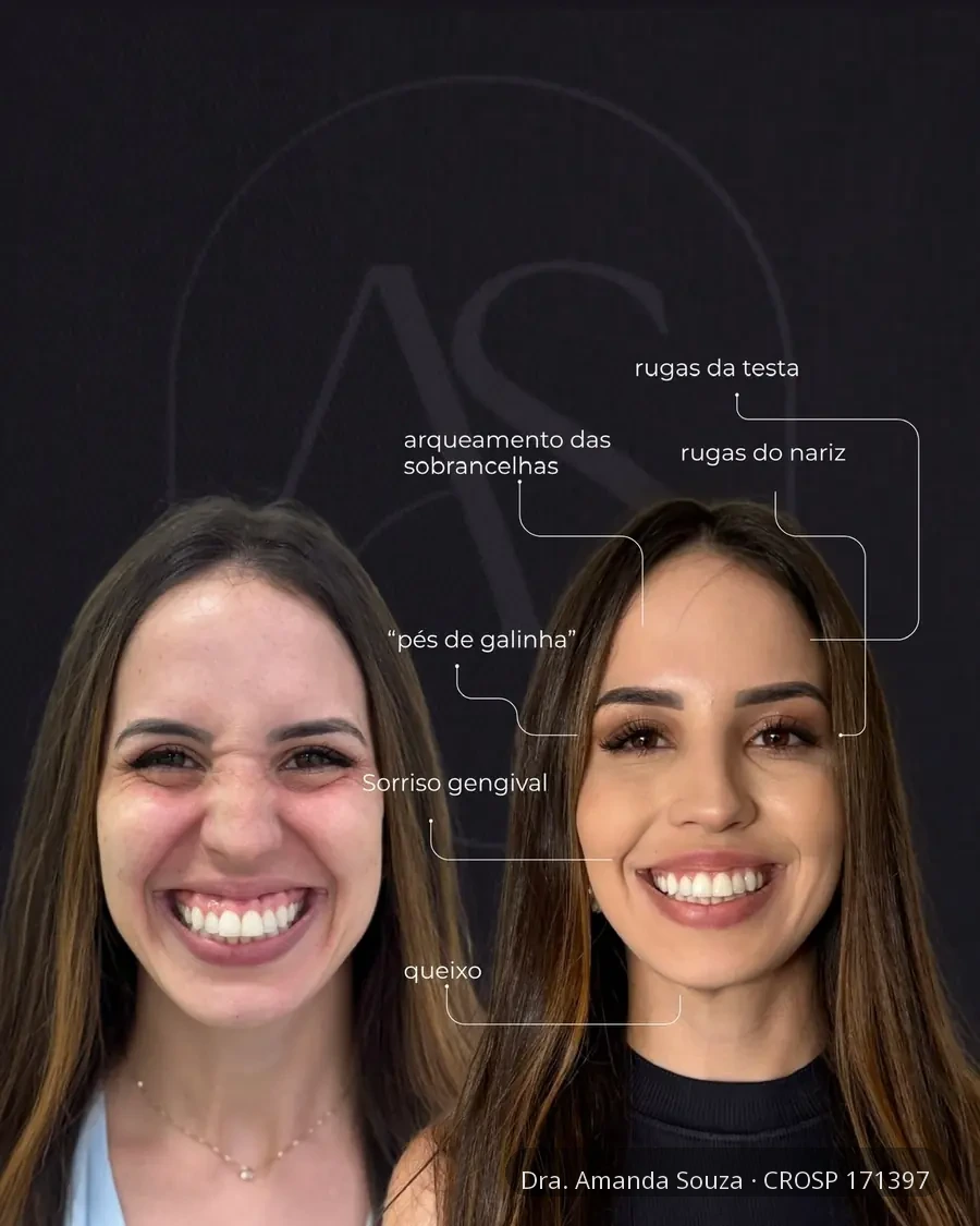 Antes e depois de áreas tratadas realizado pela Dra. Amanda Souza