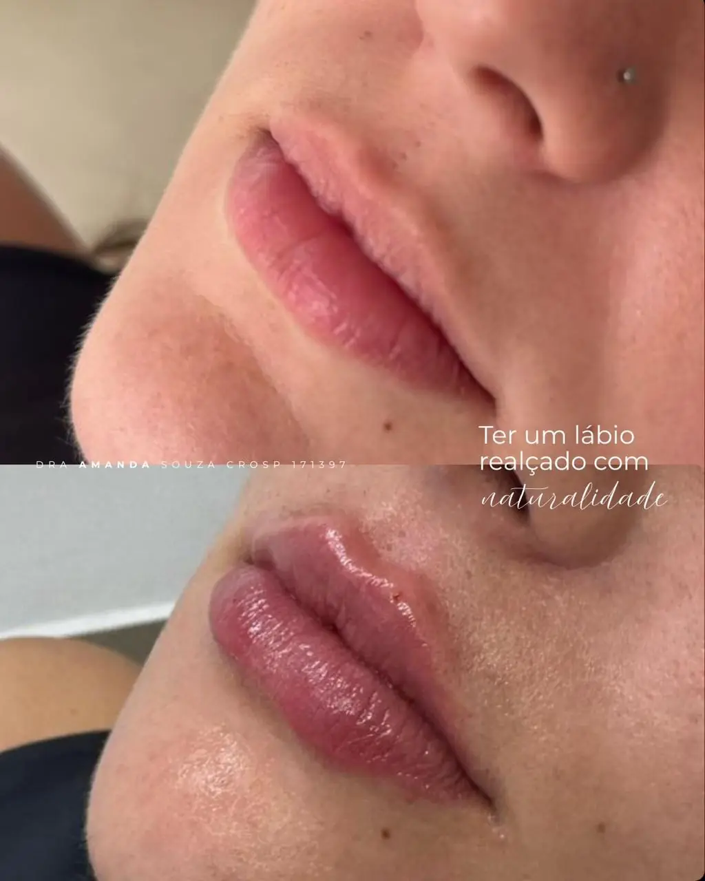 Antes e depois de preenchimento labial realizado pela Dra. Amanda Souza