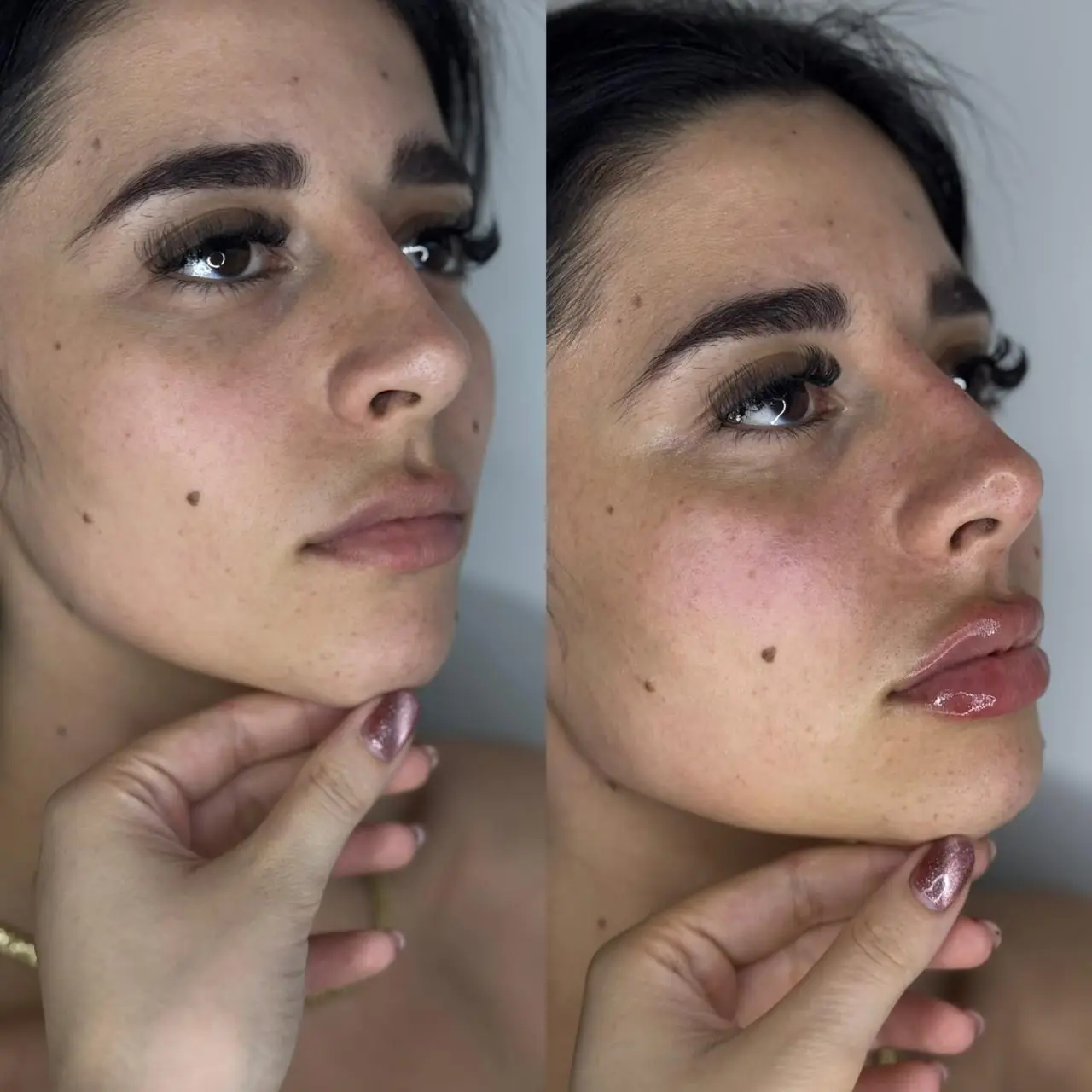 Antes e depois de harmonização completa realizado pela Dra. Amanda Souza