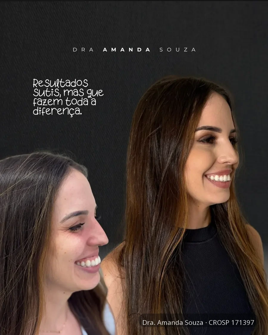 Antes e depois de perfiloplastia realizado pela Dra. Amanda Souza