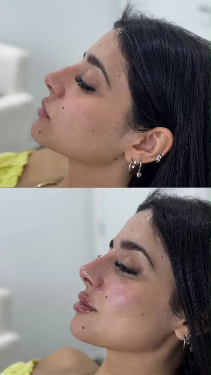 Antes e depois de perfiloplastia realizado pela Dra. Amanda Souza